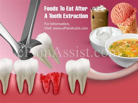 How Long After Tooth Extraction Can I Eat Solid Food: A Journey Through Time and Taste Buds